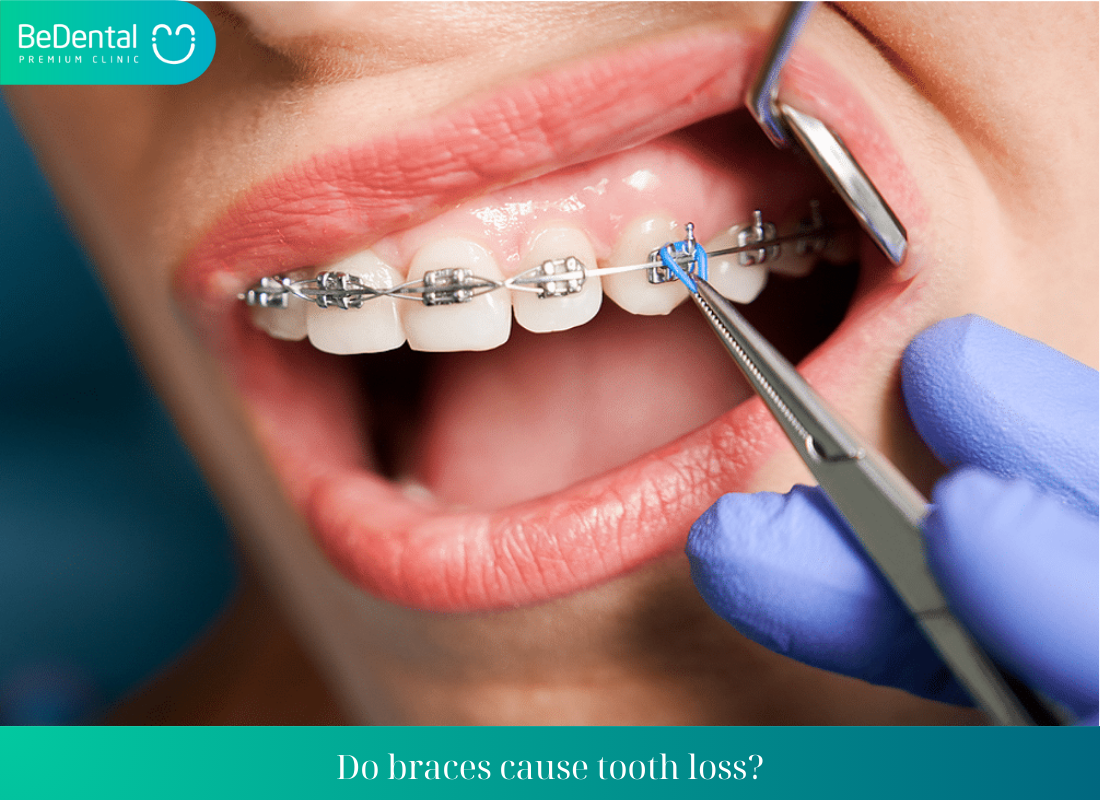 Do braces cause tooth loss