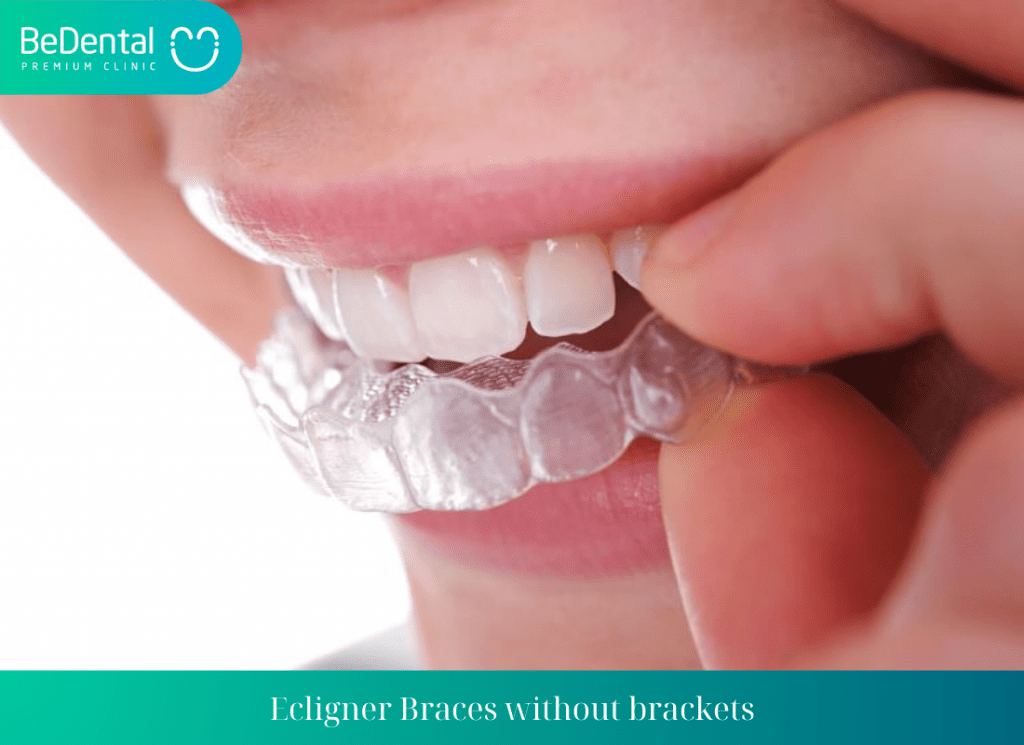 Ecligner Braces without brackets