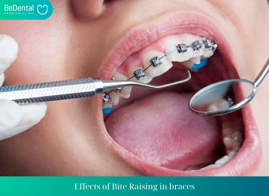 Effects of Bite Raising in braces