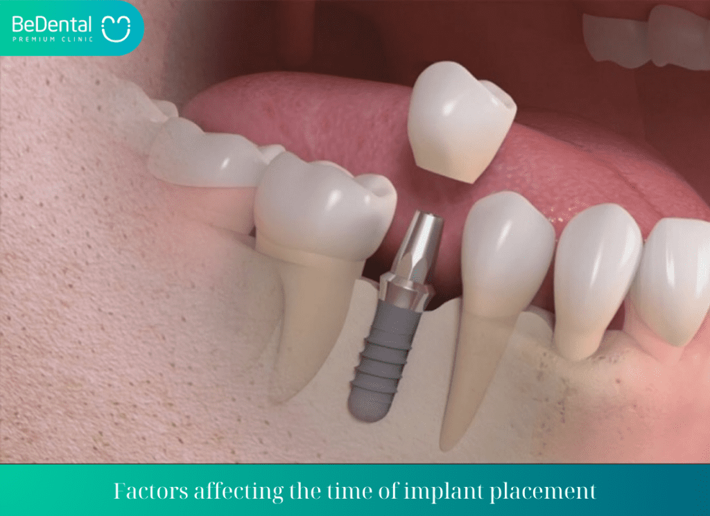 Factors affecting the time of implant placement