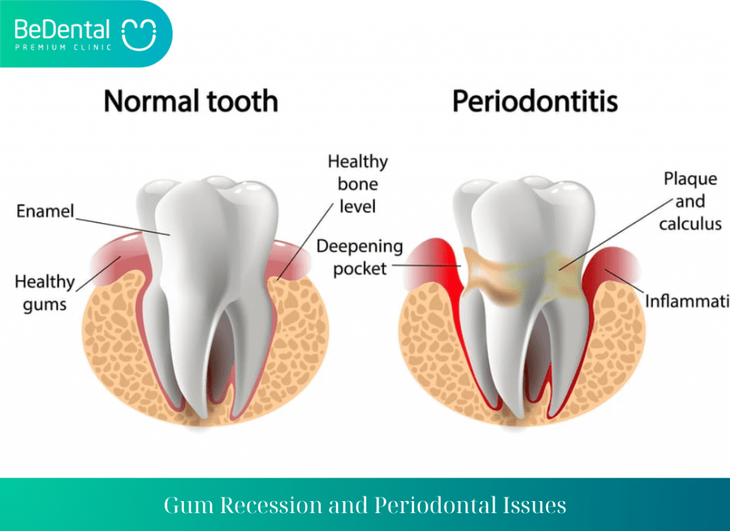 Gum Recession and Periodontal Issues 1