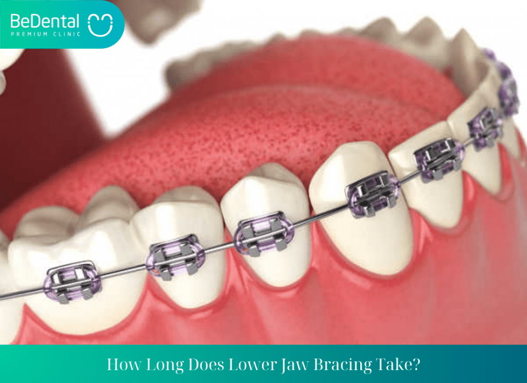 How Long Does Lower Jaw Bracing Take