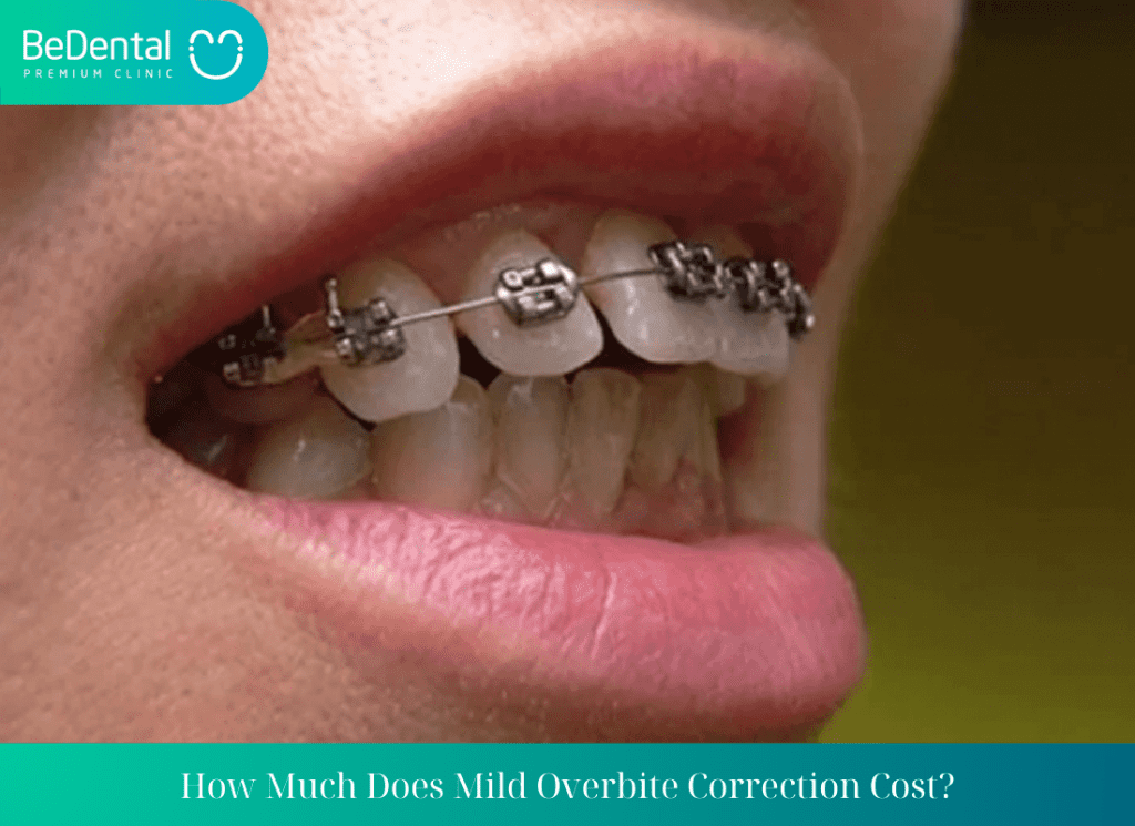 How Much Does Mild Overbite Correction Cost