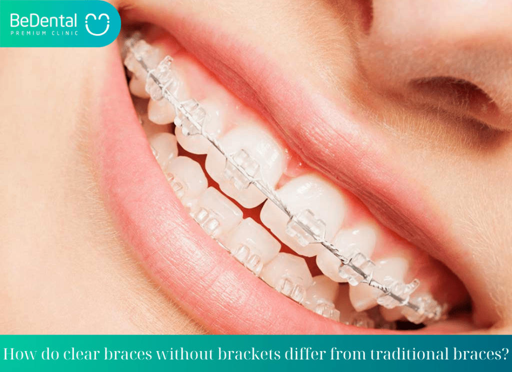 How do clear braces without brackets differ from traditional braces