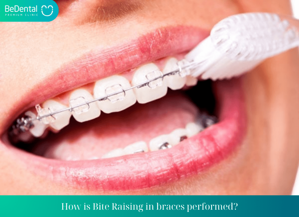 How is Bite Raising in braces performed