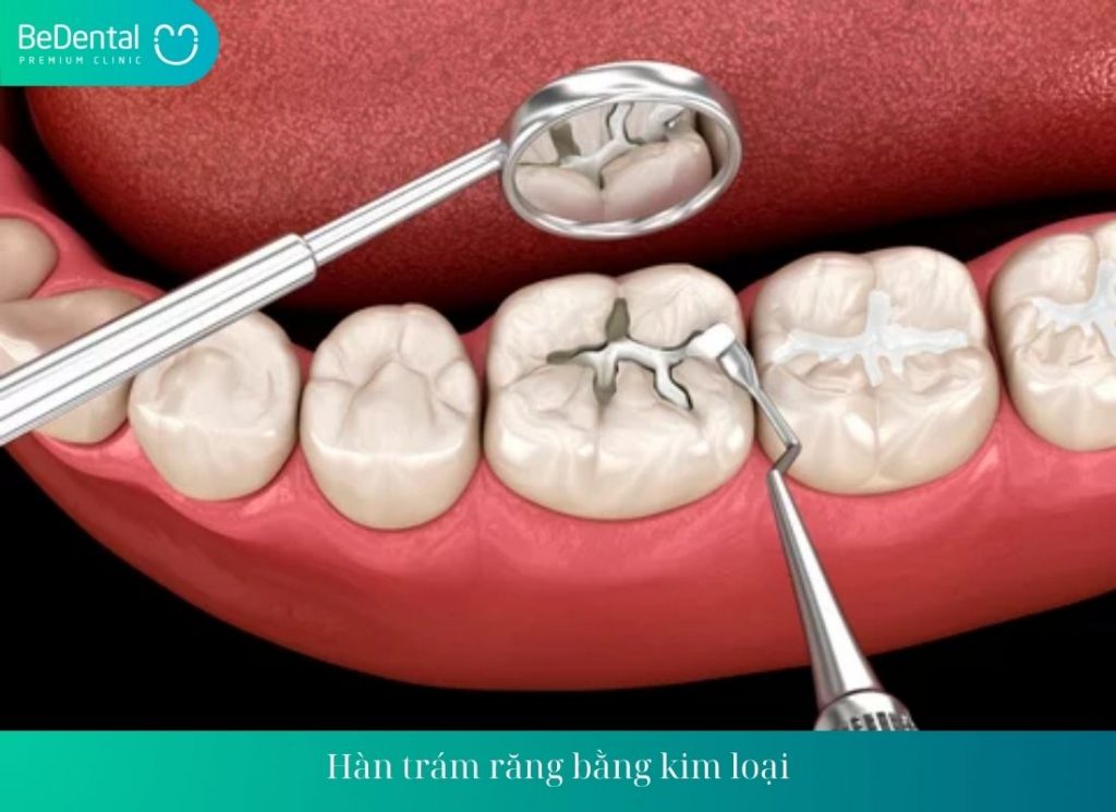 Hàn trám răng bằng kim loại