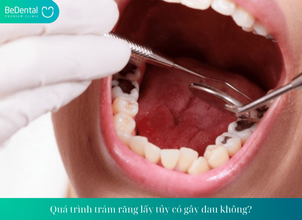 Quá trình trám răng lấy tủy có gây đau không?