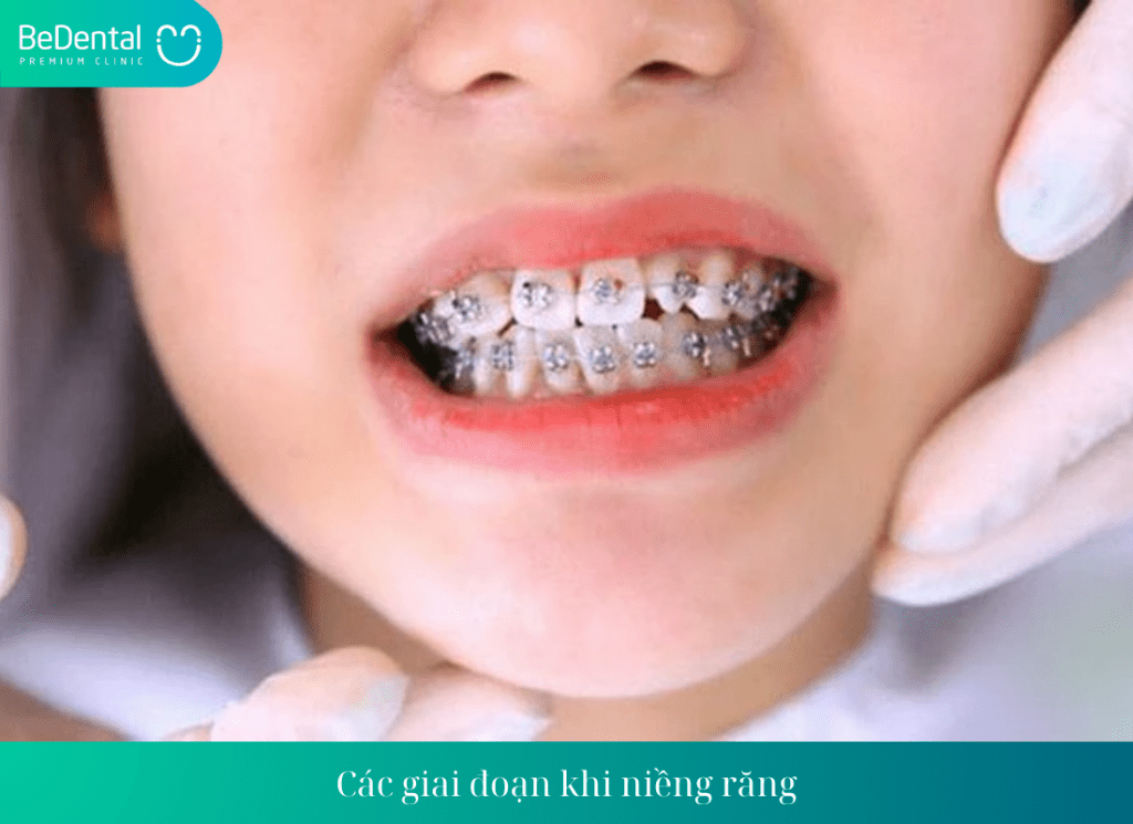 Các giai đoạn khi niềng răng