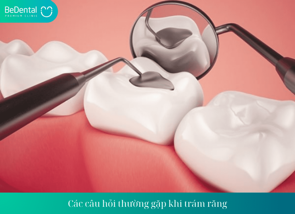 Các câu hỏi thường gặp khi trám răng