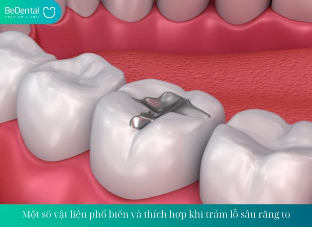 Một số vật liệu phổ biến và thích hợp khi trám lỗ sâu răng to