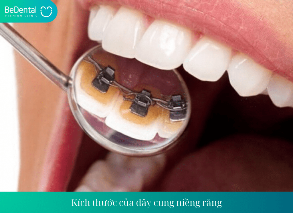 Kích thước của dây cung niềng răng