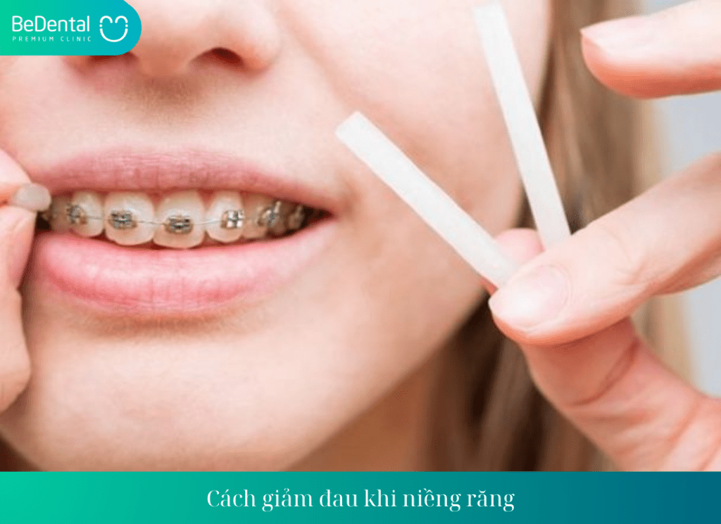 Các giai đoạn khi niềng răng