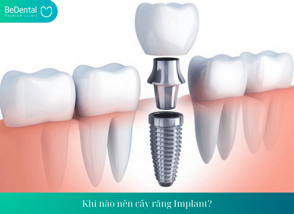 Khi nào nên cấy răng Implant?