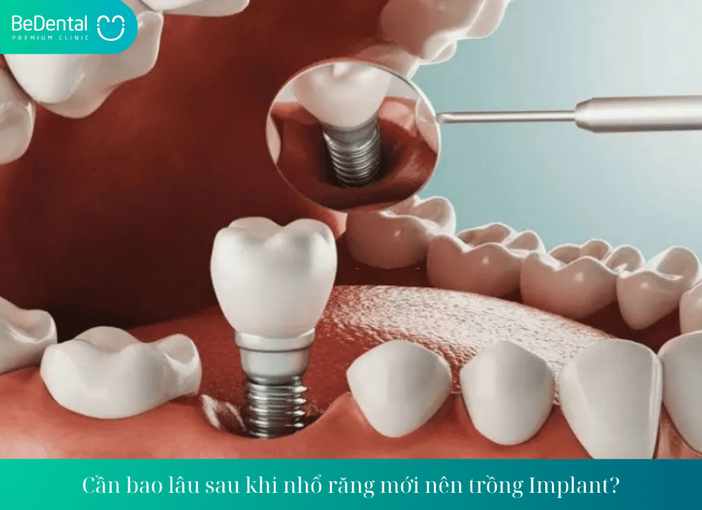 Cần bao lâu sau khi nhổ răng mới nên trồng Implant?