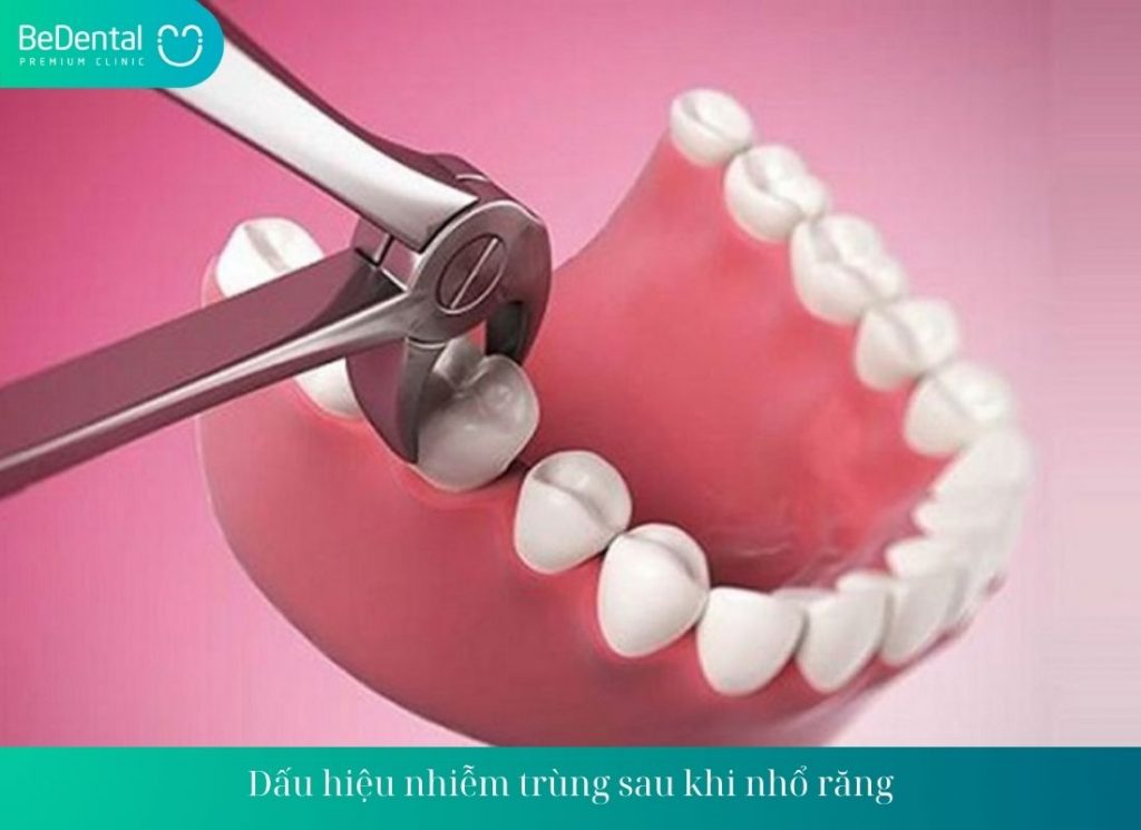 Dấu hiệu nhiễm trùng sau khi nhổ răng