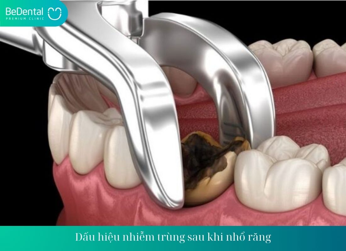 Dấu hiệu nhiễm trùng sau khi nhổ răng