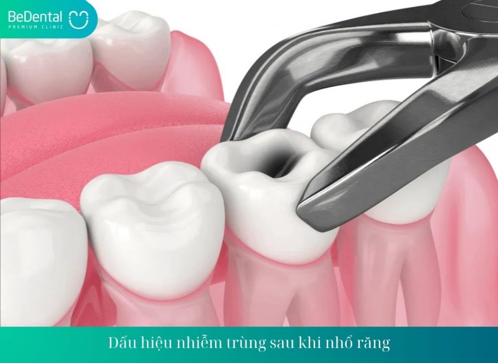 Dấu hiệu nhiễm trùng sau khi nhổ răng