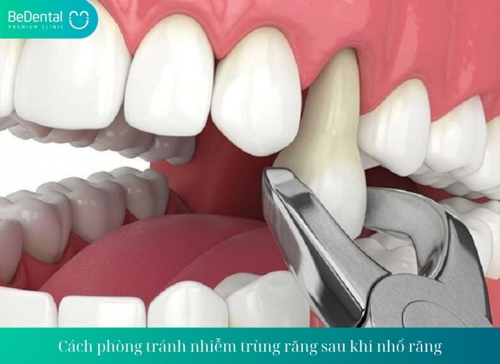 Cách phòng tránh nhiễm trùng răng sau khi nhổ răng