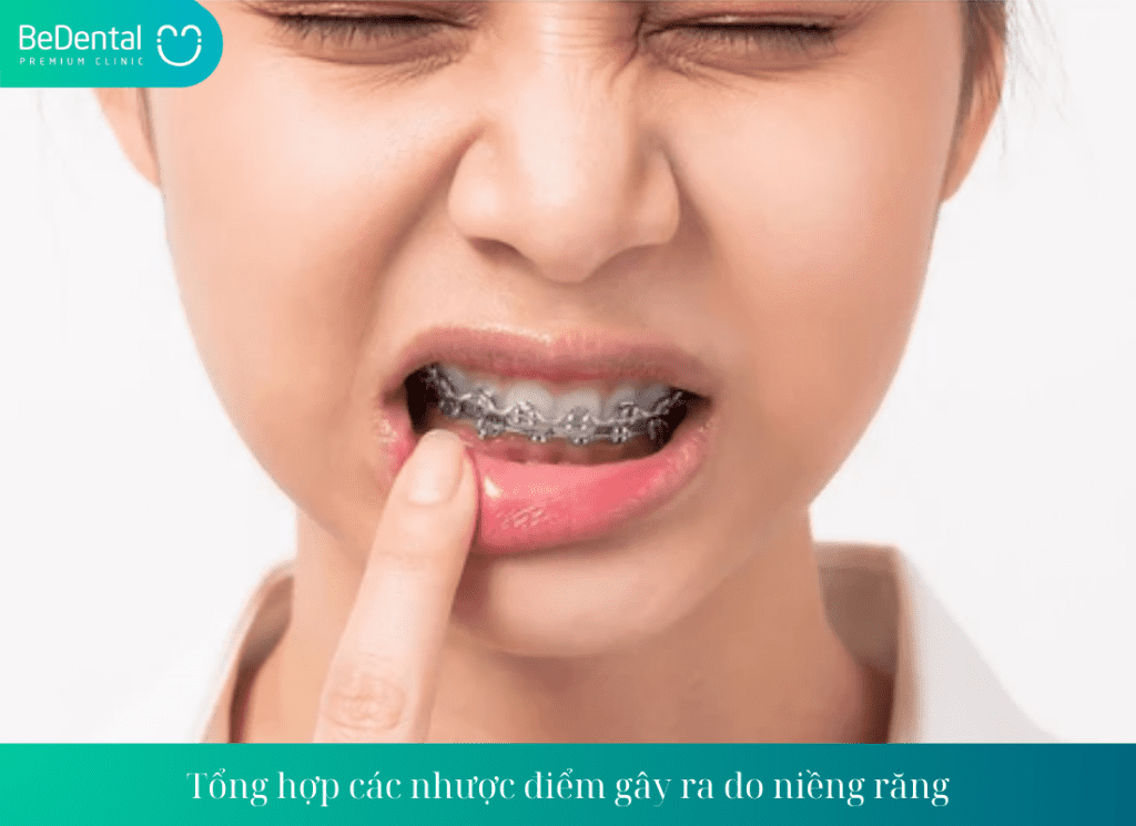 Tổng hợp các nhược điểm gây ra do niềng răng - Niềng răng có ảnh hưởng gì không?