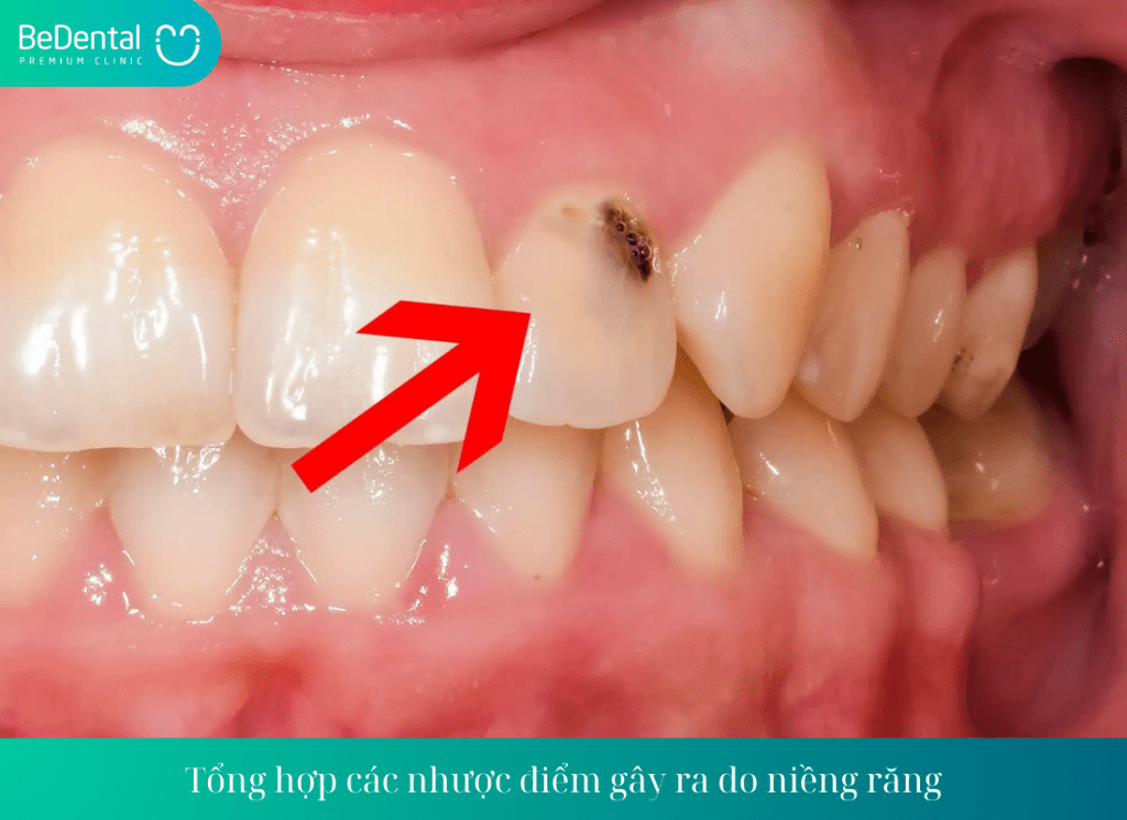 Tổng hợp các nhược điểm gây ra do niềng răng - Niềng răng có ảnh hưởng gì không?