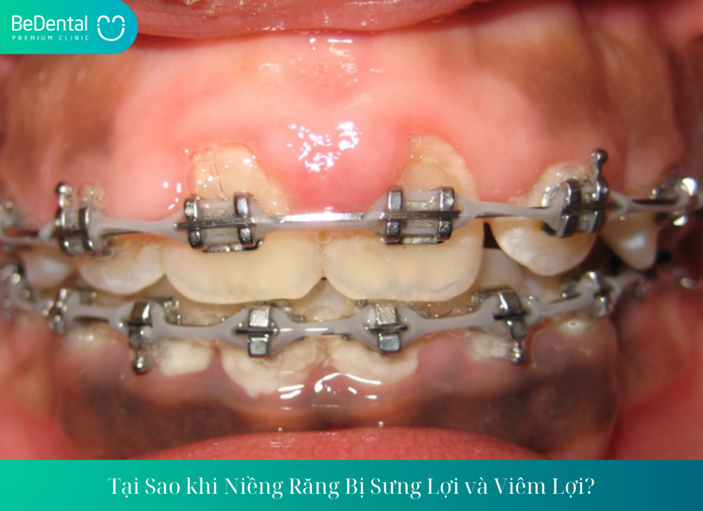 Tại sao khi niềng răng bị sưng lợi? có nguy hiểm đến lợi không?