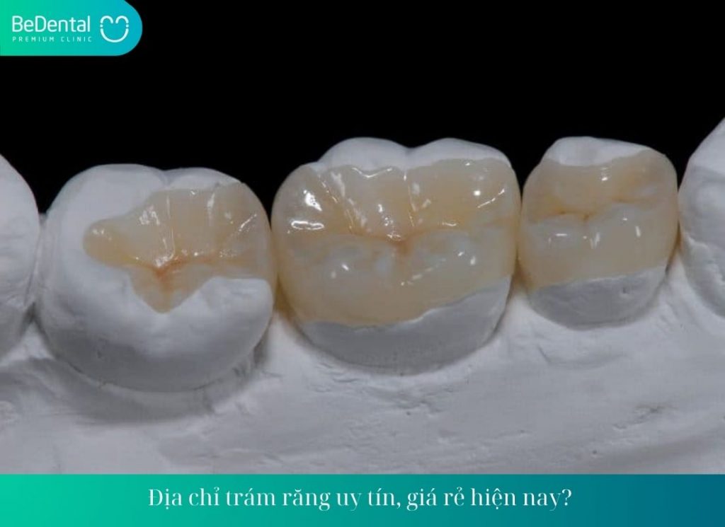 Địa chỉ trám răng uy tín, giá rẻ hiện nay? 