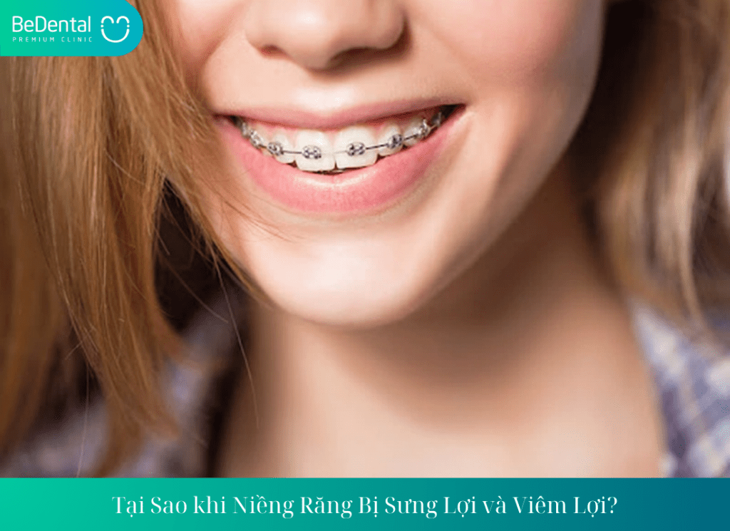 Tại sao khi niềng răng bị sưng lợi? có nguy hiểm đến lợi không?