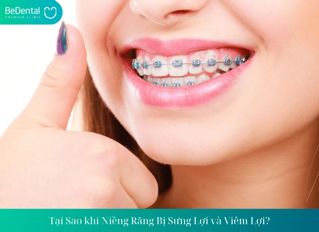 Tại sao khi niềng răng bị sưng lợi? có nguy hiểm đến lợi không?