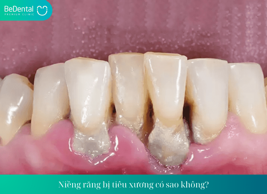 Niềng răng bị tiêu xương có sao không? Nguyên nhân dẫn đến tiêu xương khi niềng răng