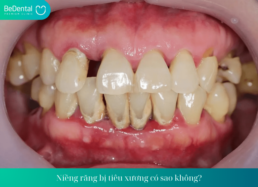 Niềng răng bị tiêu xương có sao không? Nguyên nhân dẫn đến tiêu xương khi niềng răng