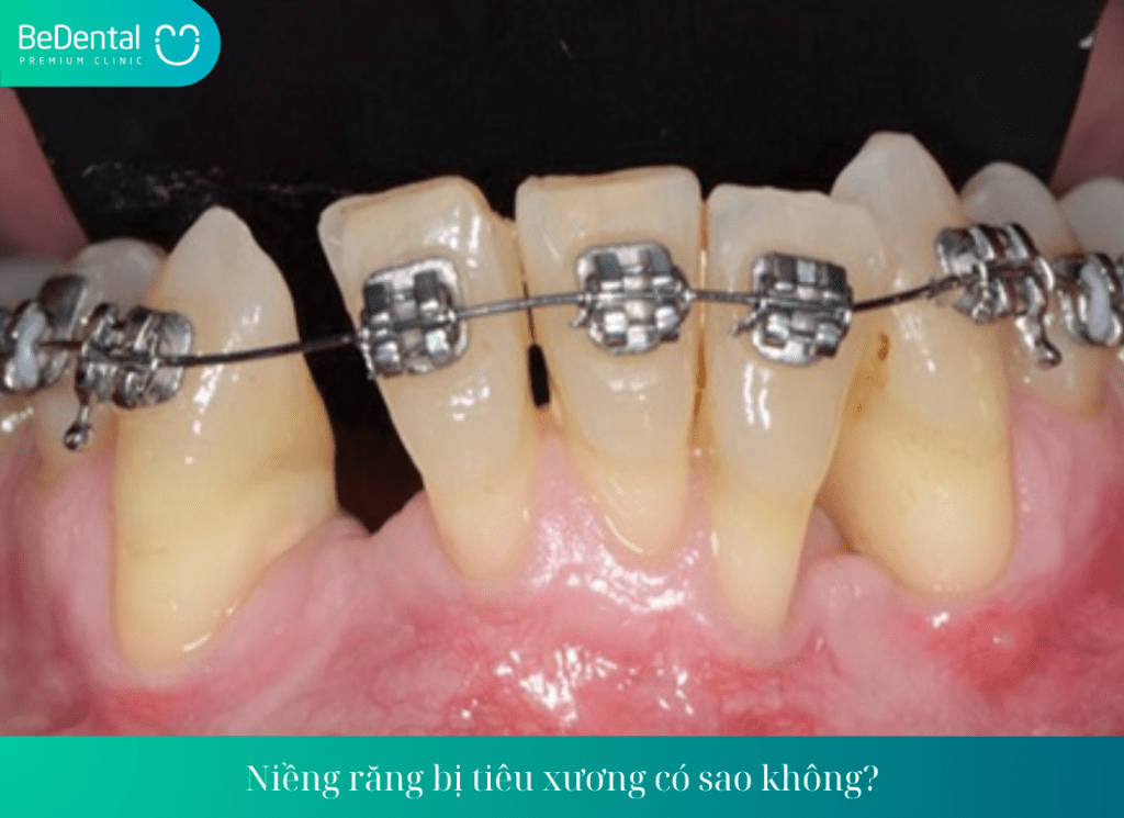 Niềng răng bị tiêu xương có sao không? Nguyên nhân dẫn đến tiêu xương khi niềng răng