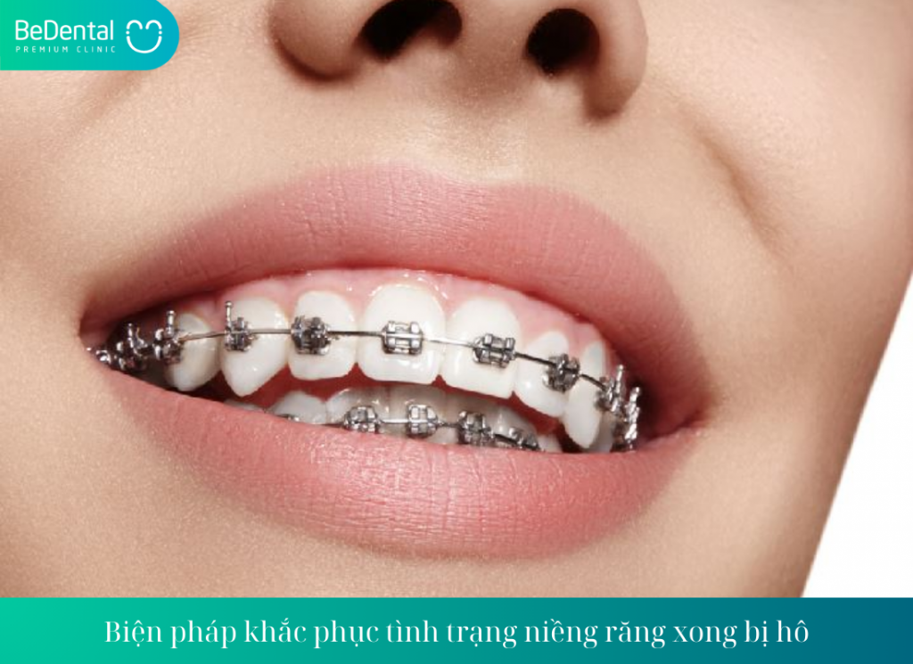 Biện pháp khắc phục tình trạng niềng răng xong bị hô