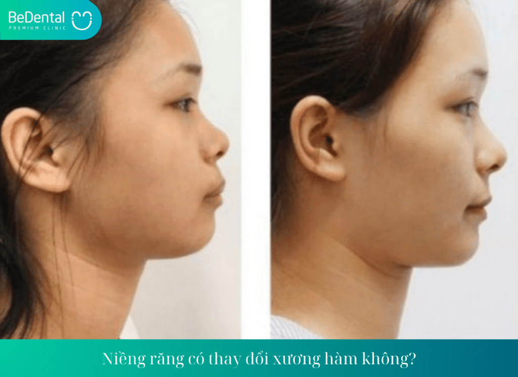 Niềng răng có thay đổi xương hàm không?