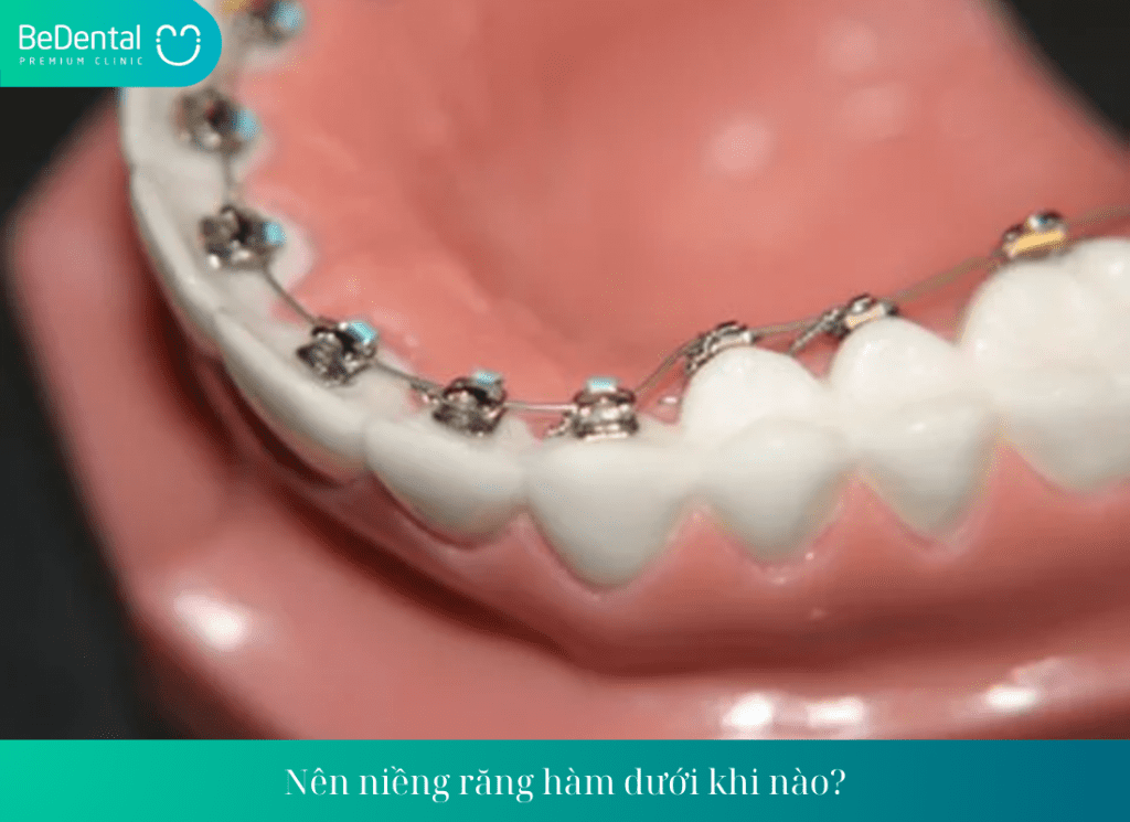 Nên niềng răng hàm dưới khi nào?