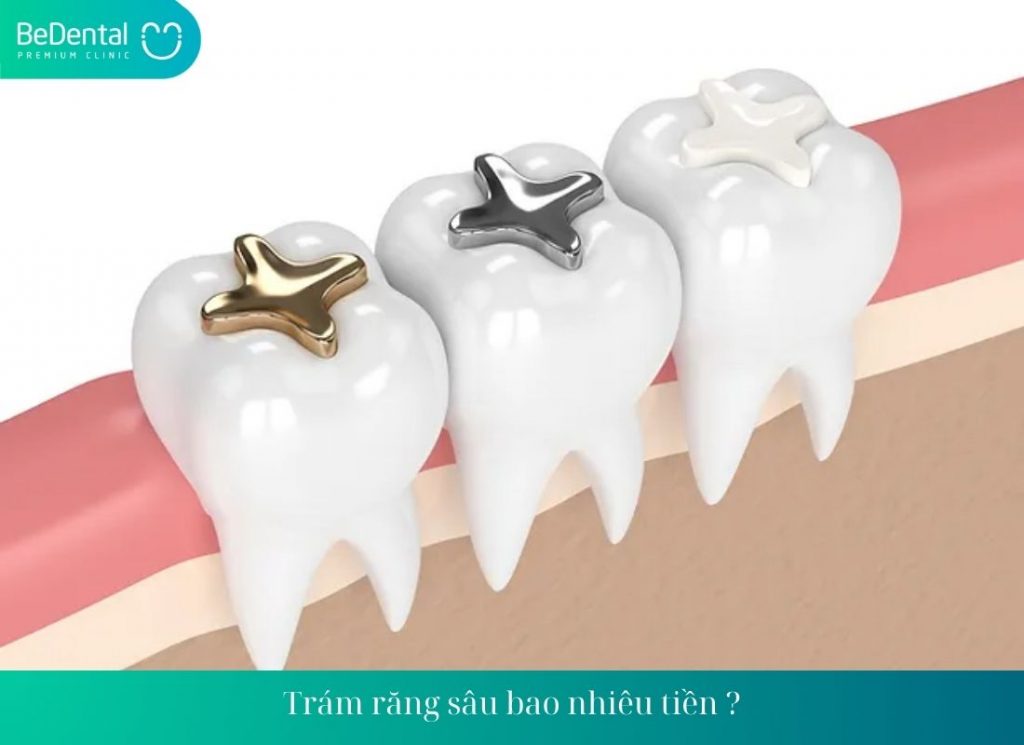 Trám răng sâu bao nhiêu tiền ?