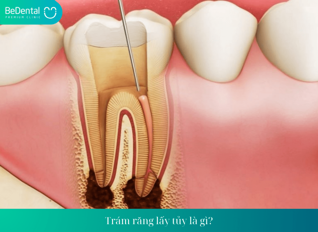 Trám răng lấy tủy là gì?