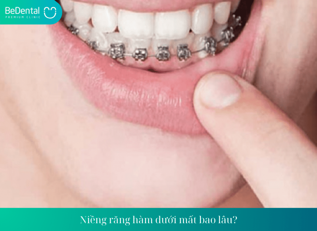 Niềng răng hàm dưới mất bao lâu?