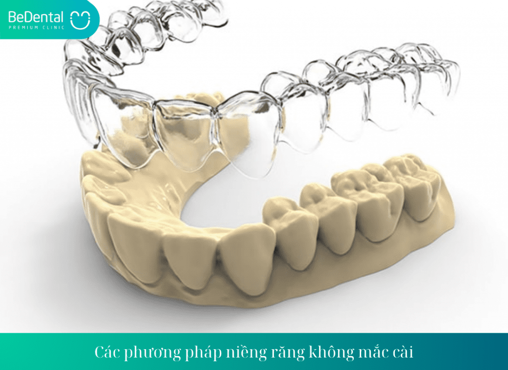 Các phương pháp niềng răng không mắc cài