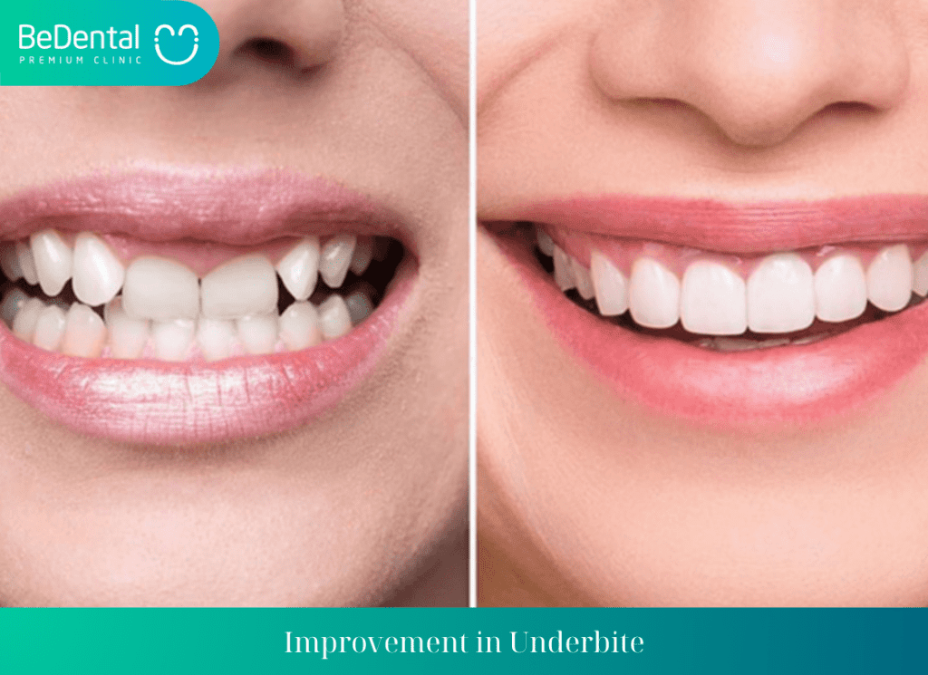 Improvement in Underbite