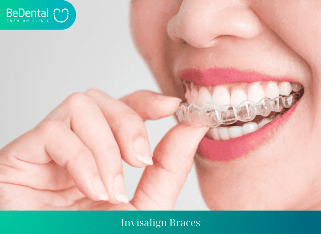 Invisalign Braces