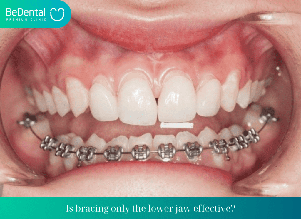 Is bracing only the lower jaw effective