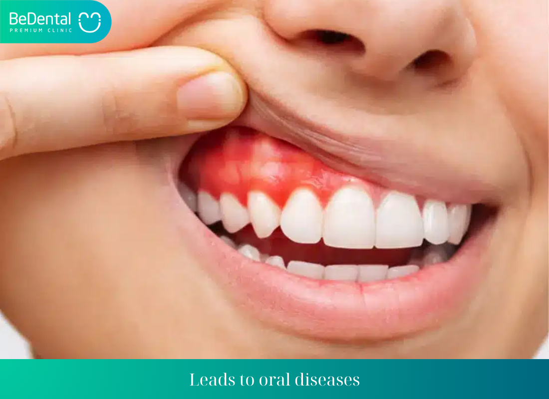 Leads to oral diseases