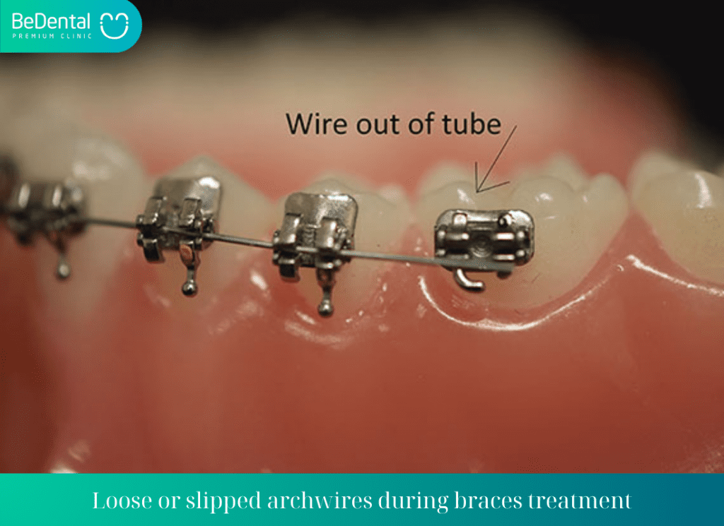 Loose or slipped archwires during braces treatment