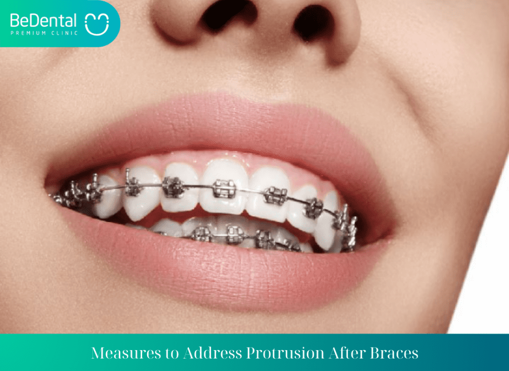 Measures to Address Protrusion After Braces