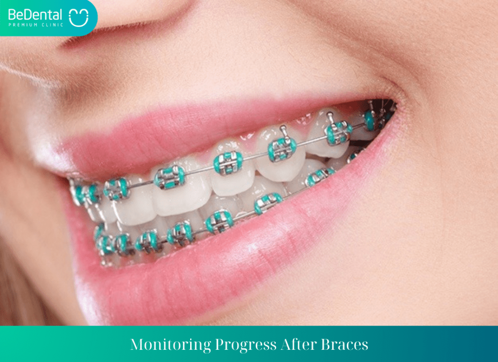 Monitoring Progress After Braces