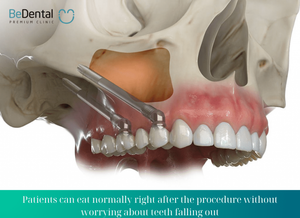 Patients can eat normally right after the procedure without worrying about teeth falling out