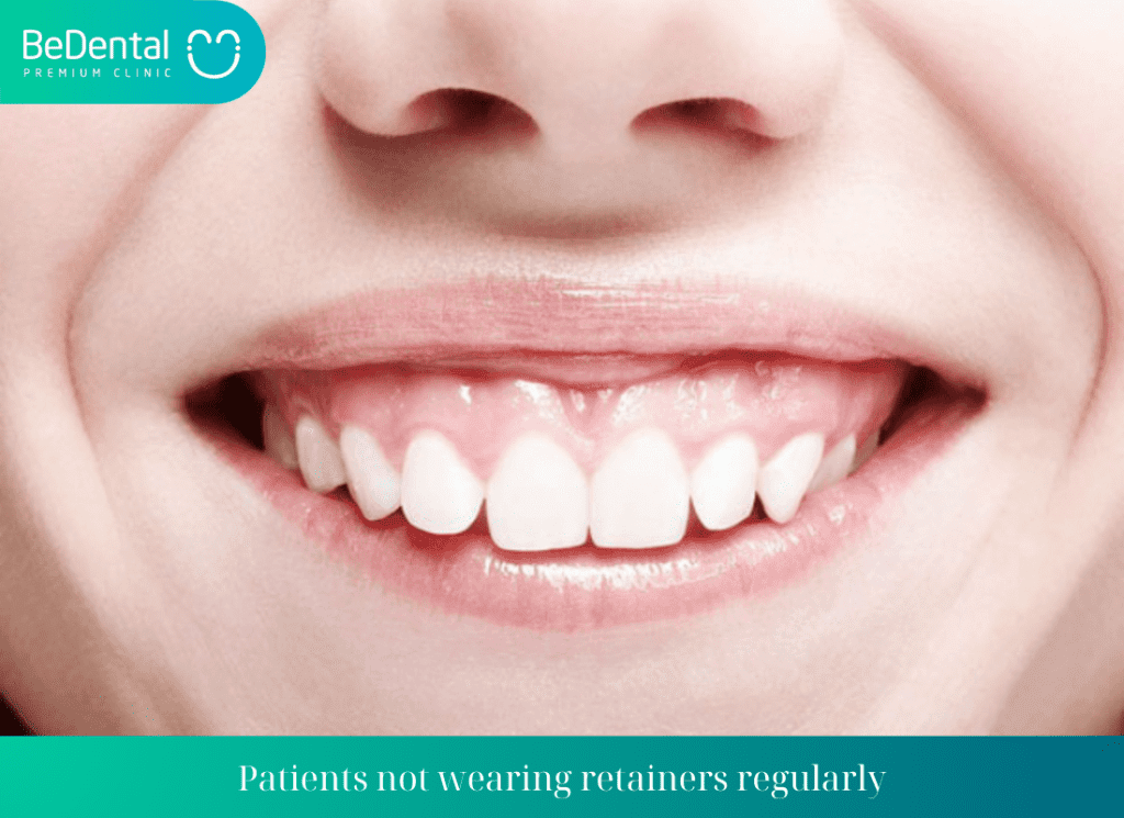 Patients not wearing retainers regularly