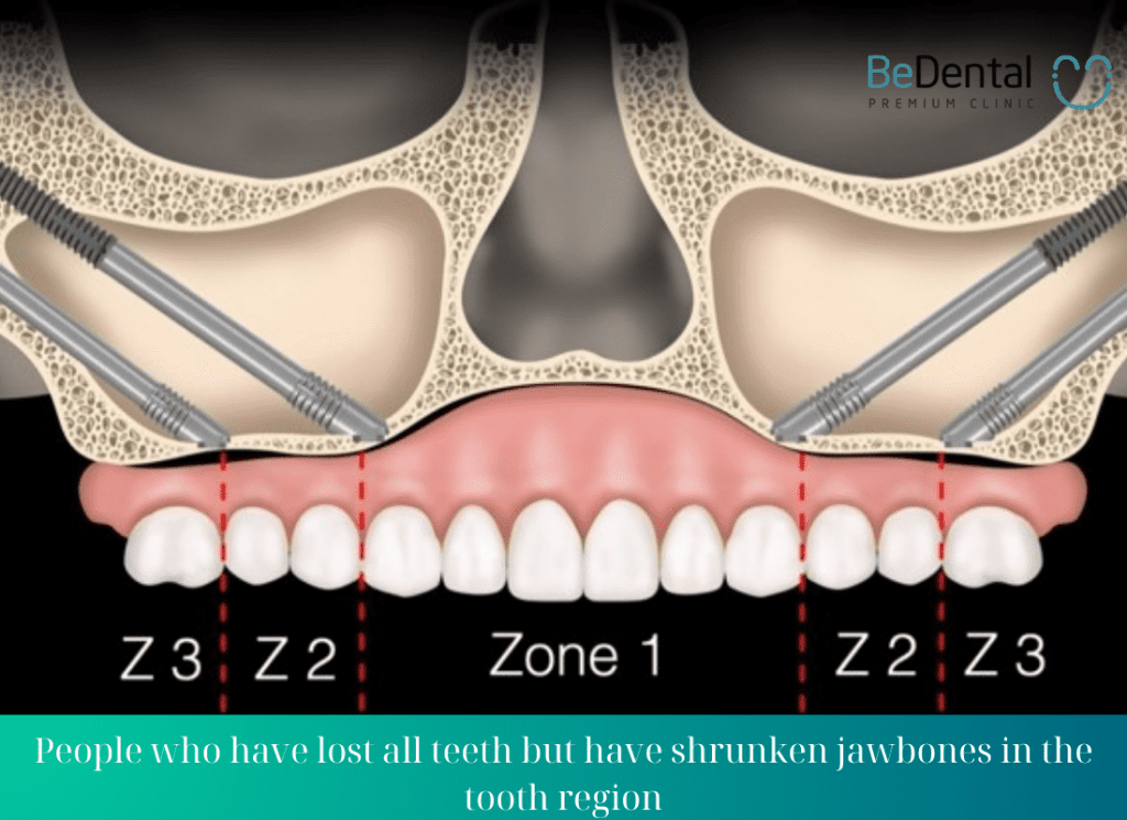 People who have lost all teeth but have shrunken jawbones in the tooth region