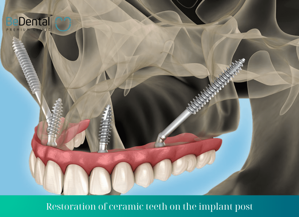 Restoration of ceramic teeth on the implant post