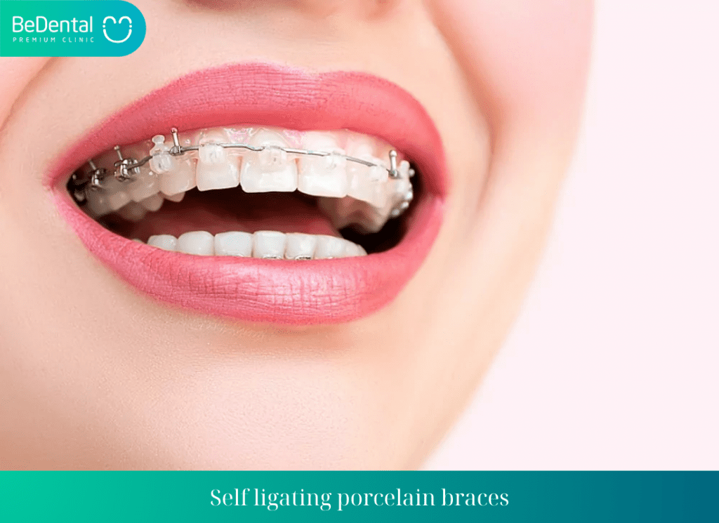 Self ligating porcelain braces